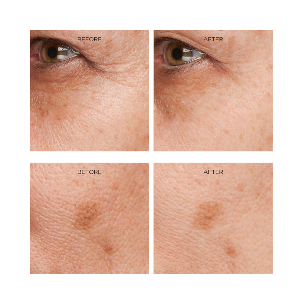 Two sets of before and after shots. The top two images display the outer corner of an eye and the before (left) shows visible eye wrinkles and the after shot (right) shows the same eye with the eye wrinkles visibly reduced. The bottom set of pictures on the before (left) shows dark hyperpigmentation spots and the after (left) shows the same spot hyper-pigmented skin drastically reduced.