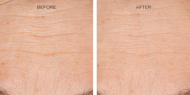 Before and after of how Erasa Skincare Products reduce forehead wrinkles. Two pictures showing a person's forehead Left Image: the before image showing visible and deep forehead lines/wrinkles. Right Image: the after shot, the forehead with a significant reduction in forehead wrinkles in a natural way.