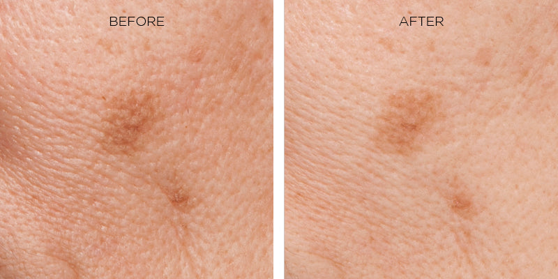 Before and after of how Erasa Skincare Products reduce hyperpigmentation. Two pictures showing a hyperpigmented spot on a person's face. Left Image: the before image with visible dark hyperpigmentation on fair skin. Right Image: the after shot, the spot with a significant reduction in hyperpigmentation. and fine lines.