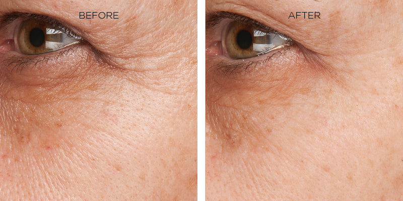 Before and after of how Erasa Skincare Products reduce eye wrinkles and fine lines. Two pictures showing a person's the outer corner of an eye. Left Image: the before image with visible eye wrinkles and fine lines. Right Image: the after shot, the same eye with a significant reduction in eye wrinkles and fine lines.